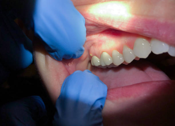 Best Emergency Gum Treatment in Waupaca, WI